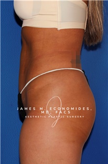 Liposuction After Photo by James Economides, MD; Arlington, VA - Case 47142