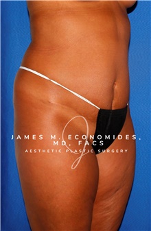 Liposuction Before Photo by James Economides, MD; Arlington, VA - Case 47142
