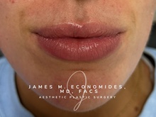 Dermal Fillers Before Photo by James Economides, MD; Arlington, VA - Case 47168