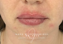 Dermal Fillers After Photo by James Economides, MD; Arlington, VA - Case 47169