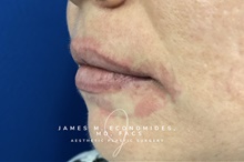 Dermal Fillers Before Photo by James Economides, MD; Arlington, VA - Case 47169
