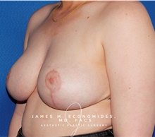 Breast Lift After Photo by James Economides, MD; Arlington, VA - Case 47171