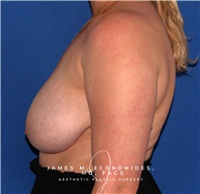 Breast Lift Before Photo by James Economides, MD; Arlington, VA - Case 47171