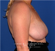 Breast Lift Before Photo by James Economides, MD; Arlington, VA - Case 47171