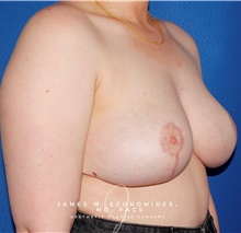 Breast Lift After Photo by James Economides, MD; Arlington, VA - Case 47171