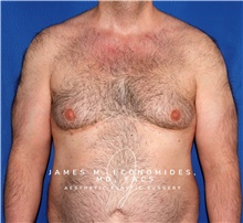 Male Breast Reduction Before Photo by James Economides, MD; Arlington, VA - Case 47325