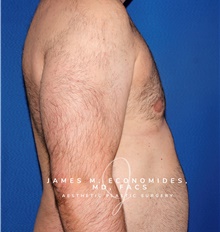 Male Breast Reduction After Photo by James Economides, MD; Arlington, VA - Case 47325