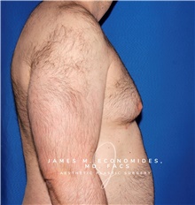 Male Breast Reduction Before Photo by James Economides, MD; Arlington, VA - Case 47325