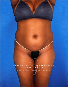 Liposuction Before Photo by James Economides, MD; Arlington, VA - Case 47513