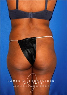 Liposuction Before Photo by James Economides, MD; Arlington, VA - Case 47513