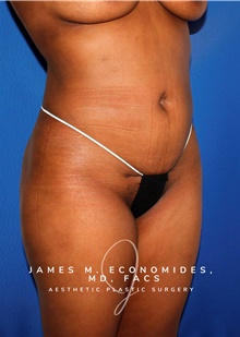Liposuction After Photo by James Economides, MD; Arlington, VA - Case 47513