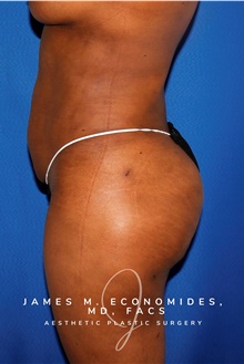 Liposuction After Photo by James Economides, MD; Arlington, VA - Case 47513
