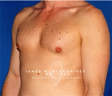 Male Breast Reduction After Photo by James Economides, MD; Arlington, VA - Case 47564