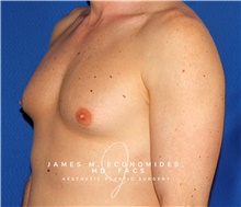 Male Breast Reduction Before Photo by James Economides, MD; Arlington, VA - Case 47564