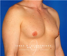 Male Breast Reduction Before Photo by James Economides, MD; Arlington, VA - Case 47564