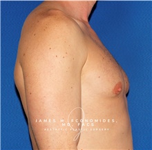 Male Breast Reduction After Photo by James Economides, MD; Arlington, VA - Case 47564