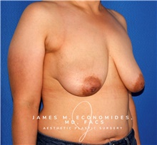 Breast Lift Before Photo by James Economides, MD; Arlington, VA - Case 47930
