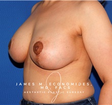 Breast Lift After Photo by James Economides, MD; Arlington, VA - Case 47930