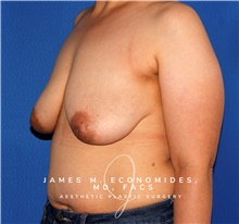 Breast Lift Before Photo by James Economides, MD; Arlington, VA - Case 47930