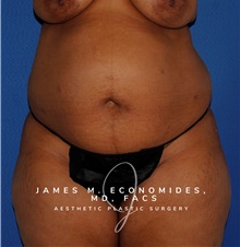 Tummy Tuck Before Photo by James Economides, MD; Arlington, VA - Case 47947