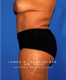 Tummy Tuck After Photo by James Economides, MD; Arlington, VA - Case 47947