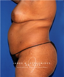 Tummy Tuck Before Photo by James Economides, MD; Arlington, VA - Case 47947
