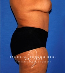 Tummy Tuck After Photo by James Economides, MD; Arlington, VA - Case 47947