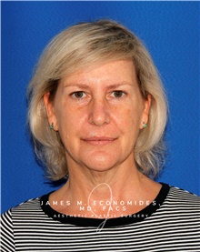 Facelift Before Photo by James Economides, MD; Arlington, VA - Case 48110
