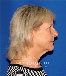 Facelift Before Photo by James Economides, MD; Arlington, VA - Case 48110