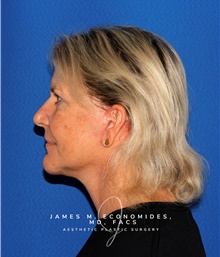 Facelift After Photo by James Economides, MD; Arlington, VA - Case 48110