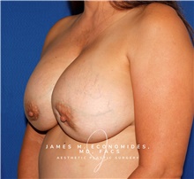 Breast Implant Revision Before Photo by James Economides, MD; Arlington, VA - Case 48274