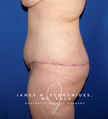 Body Lift After Photo by James Economides, MD; Arlington, VA - Case 48378