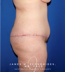 Body Lift After Photo by James Economides, MD; Arlington, VA - Case 48378