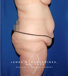 Body Lift Before Photo by James Economides, MD; Arlington, VA - Case 48378