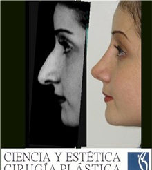 Rhinoplasty After Photo by Luis Pavajeau, MD; Bogota, CU - Case 31675