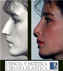 Rhinoplasty Before Photo by Luis Pavajeau, MD; Bogota, CU - Case 31675