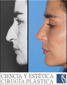 Rhinoplasty After Photo by Luis Pavajeau, MD; Bogota, CU - Case 31677