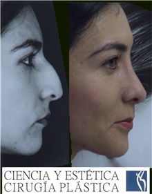 Rhinoplasty Before Photo by Luis Pavajeau, MD; Bogota, CU - Case 31677