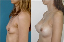 Breast Augmentation After Photo by Luis Pavajeau, MD; Bogota, CU - Case 31690