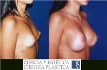 Breast Augmentation Before Photo by Luis Pavajeau, MD; Bogota, CU - Case 31690