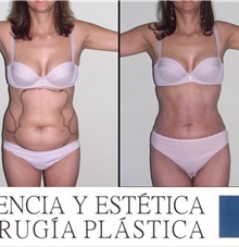 Liposuction After Photo by Luis Pavajeau, MD; Bogota, CU - Case 31691