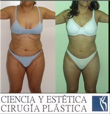 Liposuction Before Photo by Luis Pavajeau, MD; Bogota, CU - Case 31691