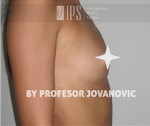 Breast Augmentation Before Photo by Milan Jovanovic, MD, PhD; Belgrade,  - Case 37779