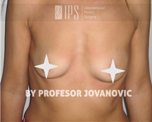 Breast Augmentation Before Photo by Milan Jovanovic, MD, PhD; Belgrade,  - Case 37779
