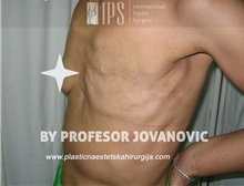 Breast Reconstruction Before Photo by Milan Jovanovic, MD, PhD; Belgrade,  - Case 37783