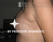 Breast Reconstruction After Photo by Milan Jovanovic, MD, PhD; Belgrade,  - Case 37783