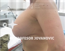 Breast Lift After Photo by Milan Jovanovic, MD, PhD; Belgrade,  - Case 37784