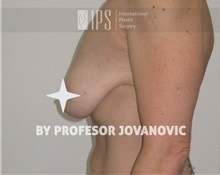 Breast Lift Before Photo by Milan Jovanovic, MD, PhD; Belgrade,  - Case 37784