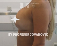 Breast Lift After Photo by Milan Jovanovic, MD, PhD; Belgrade,  - Case 37784