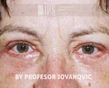 Eyelid Ptosis Repair After Photo by Milan Jovanovic, MD, PhD; Belgrade,  - Case 37824